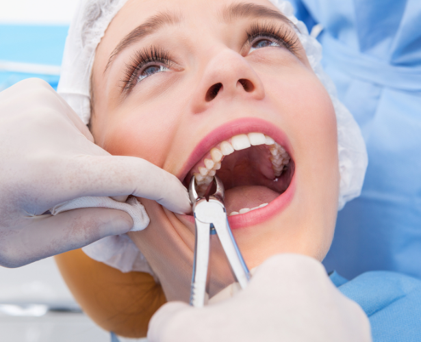 Dentist removing an upper tooth with forceps during extraction